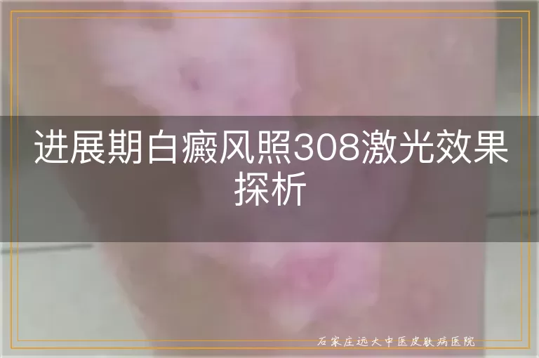 进展期白癜风照308激光效果探析