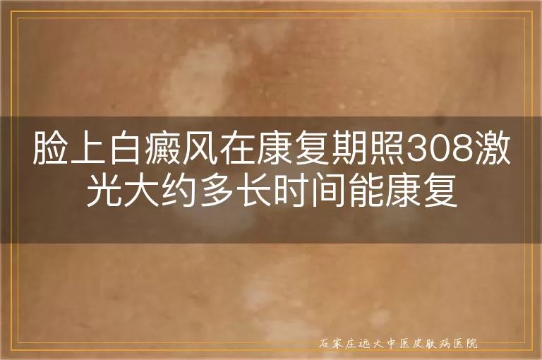 脸上白癜风在康复期照308激光大约多长时间能康复