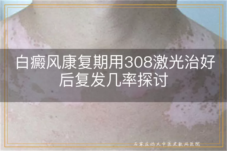 白癜风康复期用308激光治好后复发几率探讨