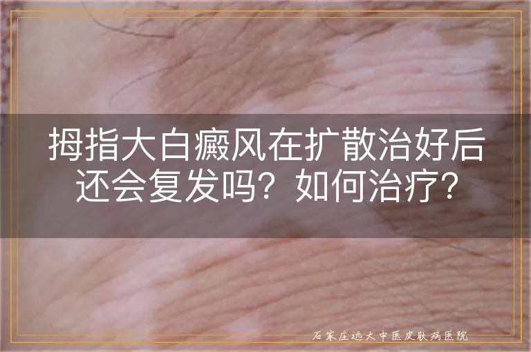 拇指大白癜风在扩散治好后还会复发吗？如何治疗？