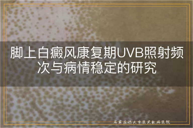脚上白癜风康复期UVB照射频次与病情稳定的研究