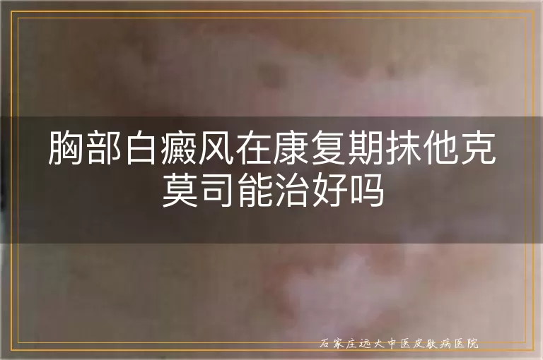 胸部白癜风在康复期抹他克莫司能治好吗