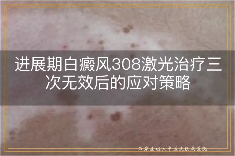 进展期白癜风308激光治疗三次无效后的应对策略
