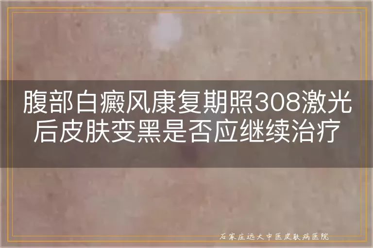 腹部白癜风康复期照308激光后皮肤变黑是否应继续治疗？