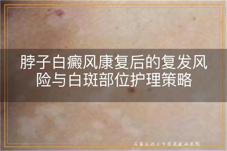 脖子白癜风康复后的复发风险与白斑部位护理策略