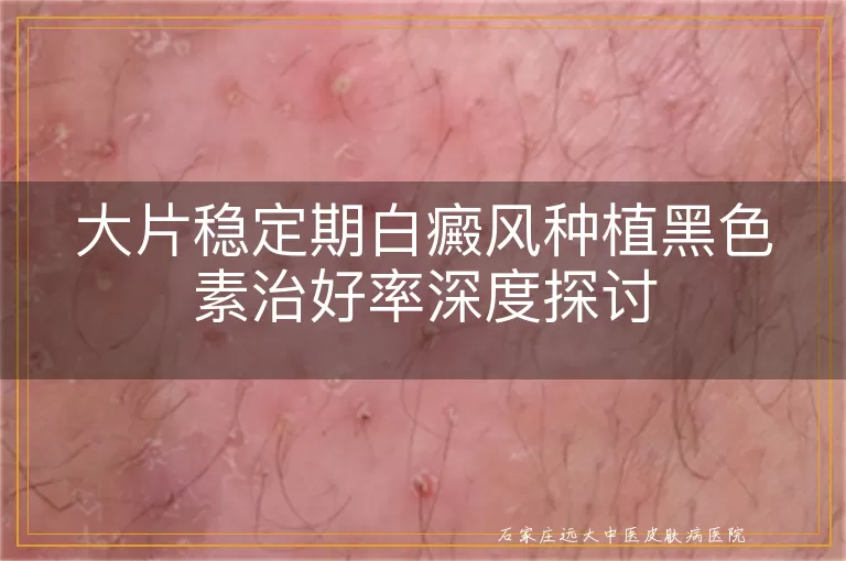 大片稳定期白癜风种植黑色素治好率深度探讨