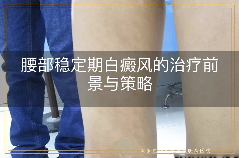 腰部稳定期白癜风的治疗前景与策略