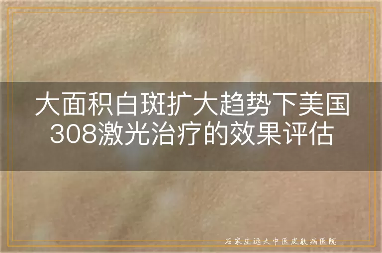大面积白斑扩大趋势下美国308激光治疗的效果评估