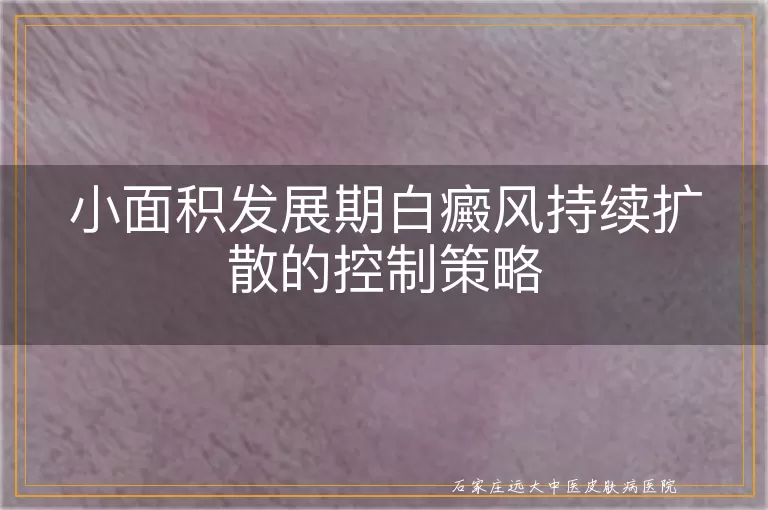 小面积发展期白癜风持续扩散的控制策略