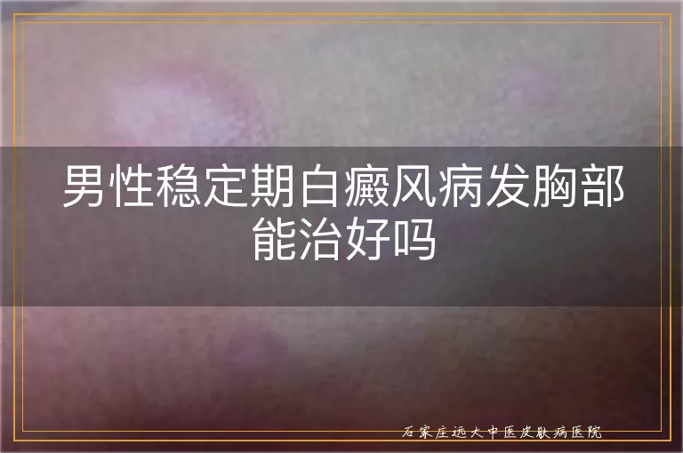 男性稳定期白癜风病发胸部能治好吗