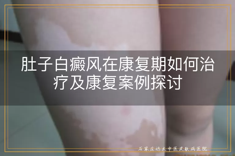 肚子白癜风在康复期如何治疗及康复案例探讨