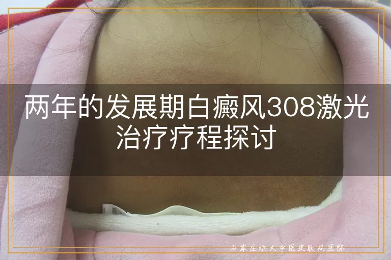 两年的发展期白癜风308激光治疗疗程探讨