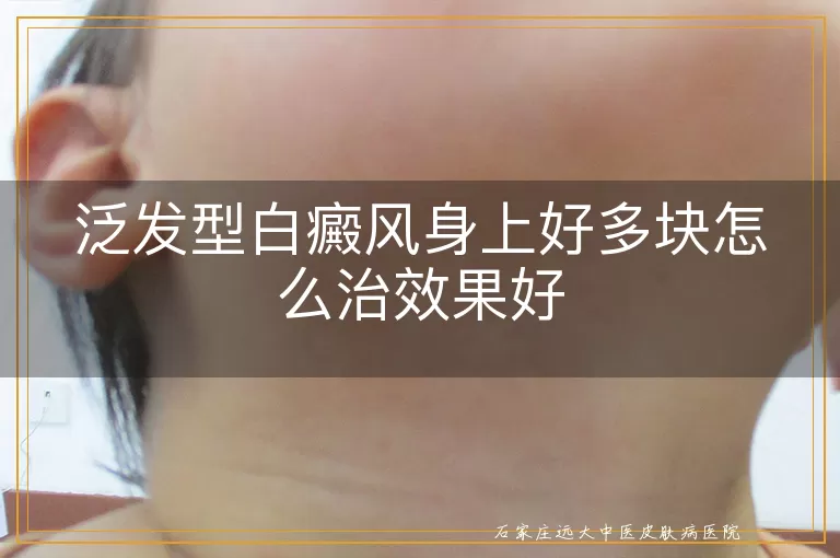 泛发型白癜风身上好多块怎么治效果好