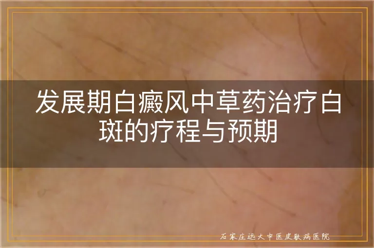 发展期白癜风中草药治疗白斑的疗程与预期