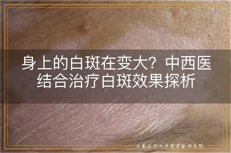身上的白斑在变大？中西医结合治疗白斑效果探析