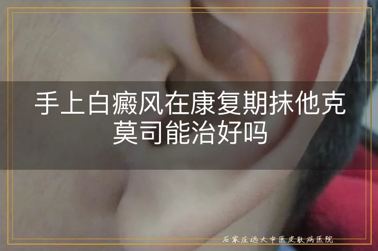 手上白癜风在康复期抹他克莫司能治好吗
