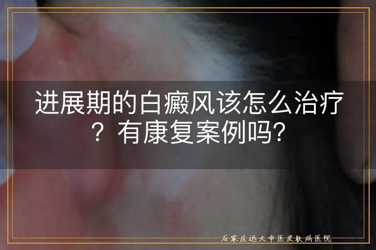 进展期的白癜风该怎么治疗？有康复案例吗？