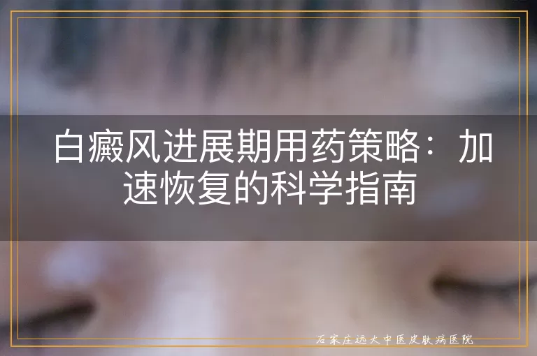 白癜风进展期用药策略：加速恢复的科学指南