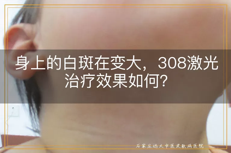 身上的白斑在变大，308激光治疗效果如何？