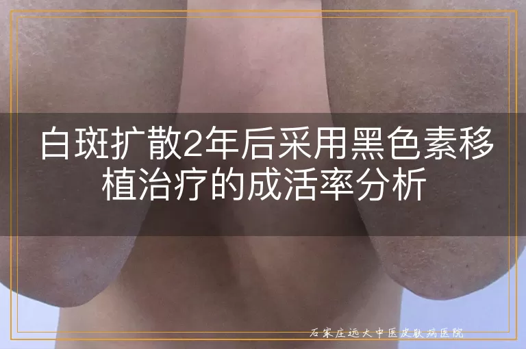 白斑扩散2年后采用黑色素移植治疗的成活率分析