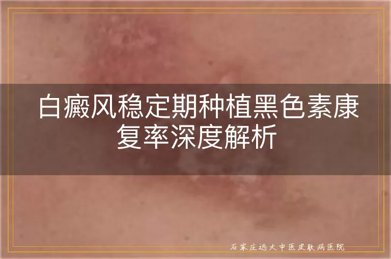 白癜风稳定期种植黑色素康复率深度解析