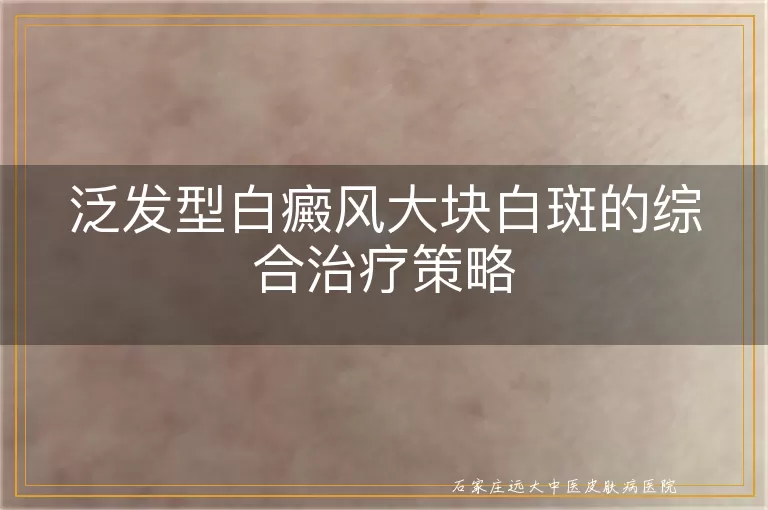 泛发型白癜风大块白斑的综合治疗策略