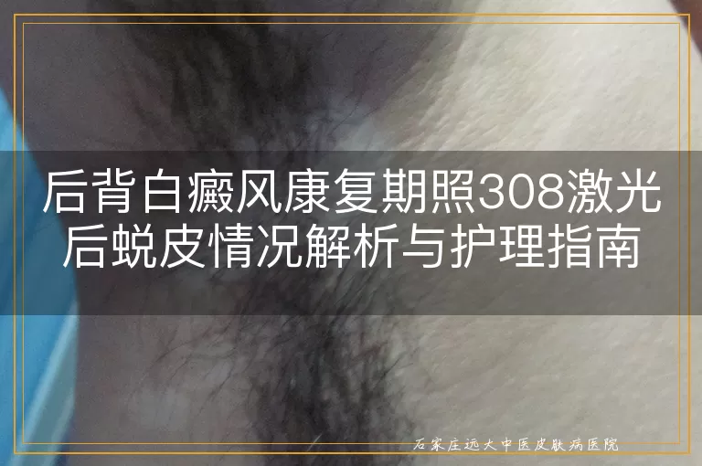 后背白癜风康复期照308激光后蜕皮情况解析与护理指南