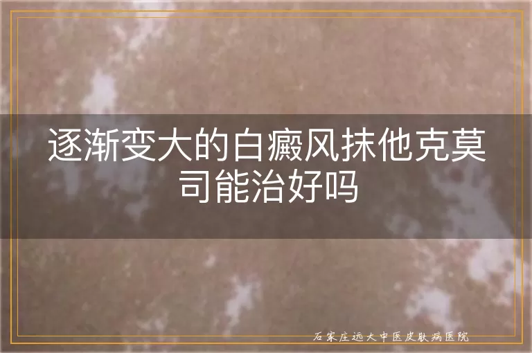 逐渐变大的白癜风抹他克莫司能治好吗