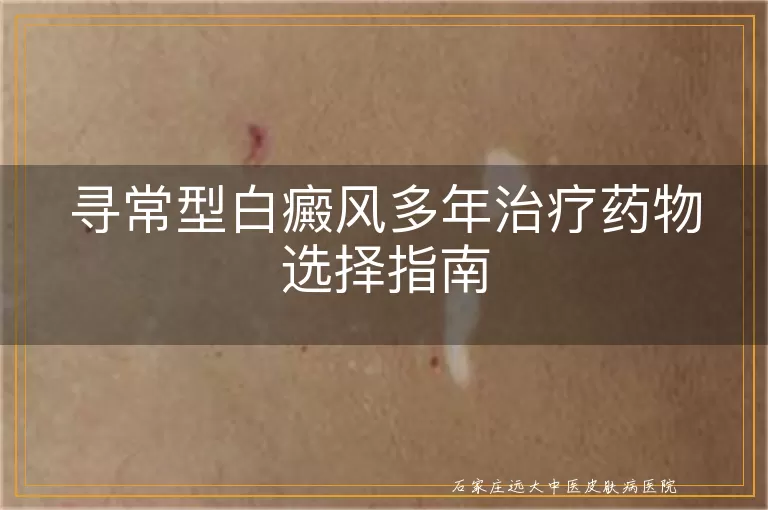 寻常型白癜风多年治疗药物选择指南