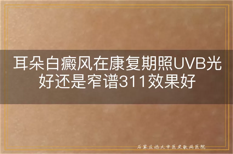 耳朵白癜风在康复期照UVB光好还是窄谱311效果好