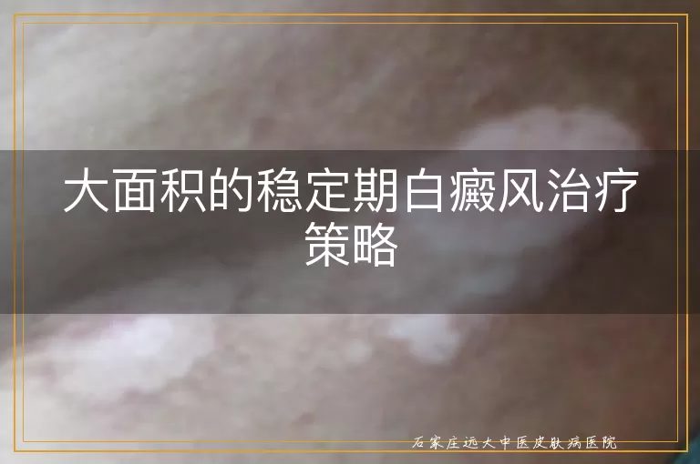 大面积的稳定期白癜风治疗策略