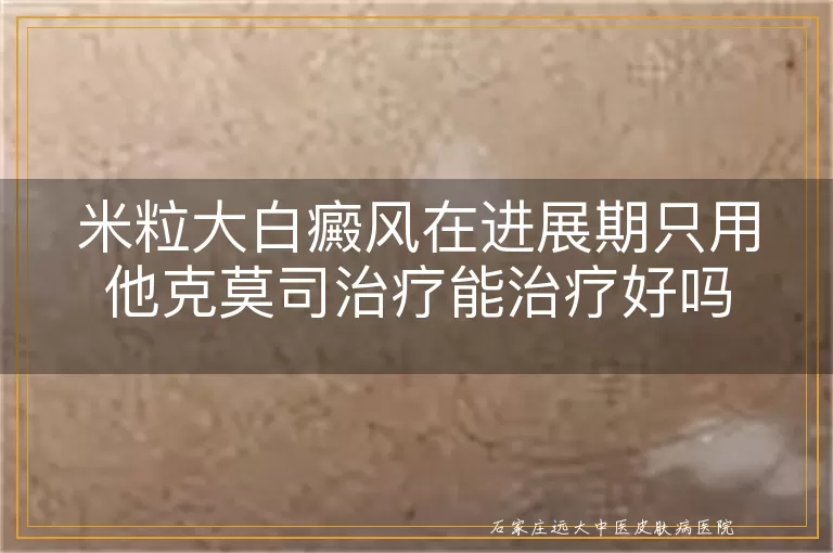 米粒大白癜风在进展期只用他克莫司治疗能治疗好吗