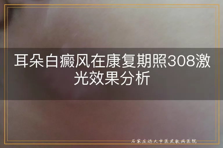 耳朵白癜风在康复期照308激光效果分析