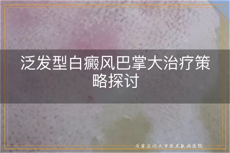 泛发型白癜风巴掌大治疗策略探讨