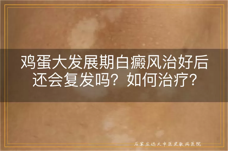 鸡蛋大发展期白癜风治好后还会复发吗？如何治疗？