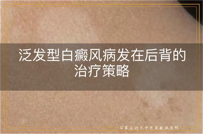 泛发型白癜风病发在后背的治疗策略