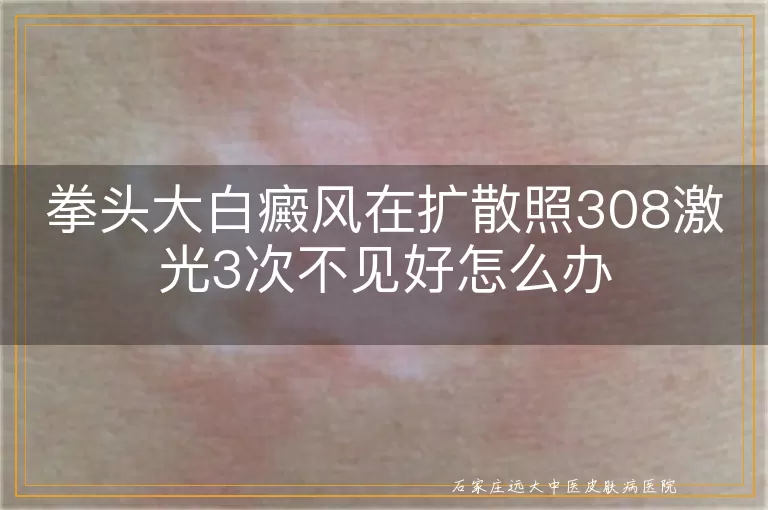 拳头大白癜风在扩散照308激光3次不见好怎么办