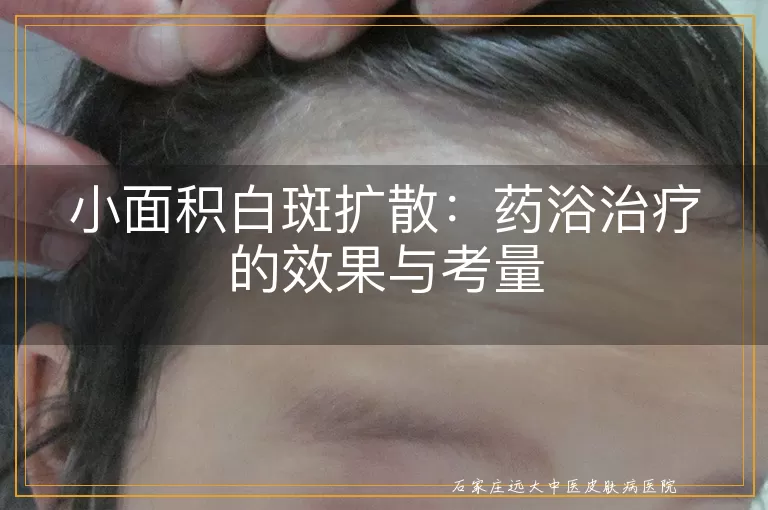 小面积白斑扩散：药浴治疗的效果与考量