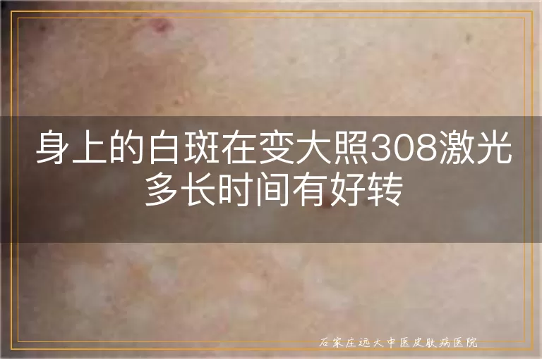 身上的白斑在变大照308激光多长时间有好转