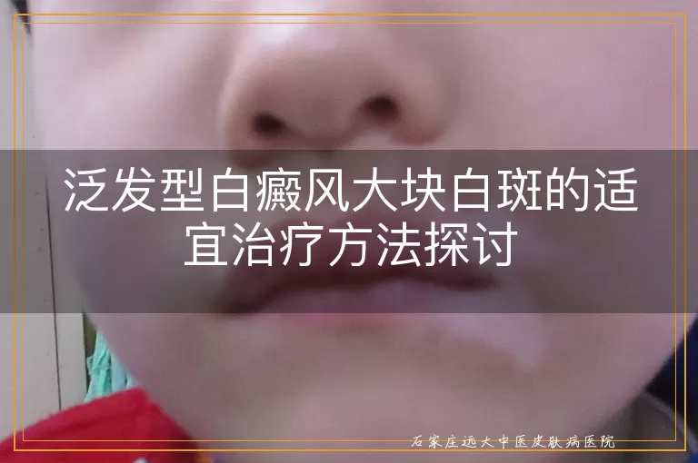 泛发型白癜风大块白斑的适宜治疗方法探讨