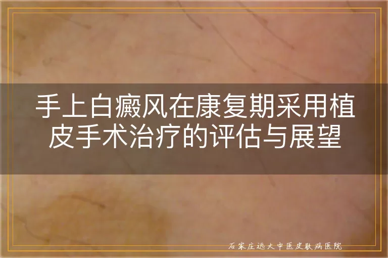 手上白癜风在康复期采用植皮手术治疗的评估与展望