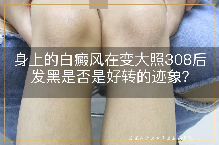 身上的白癜风在变大照308后发黑是否是好转的迹象？