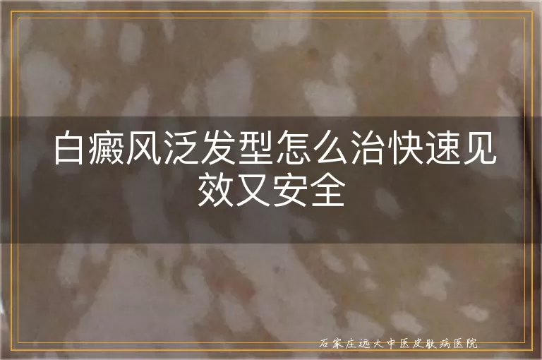 白癜风泛发型怎么治快速见效又安全