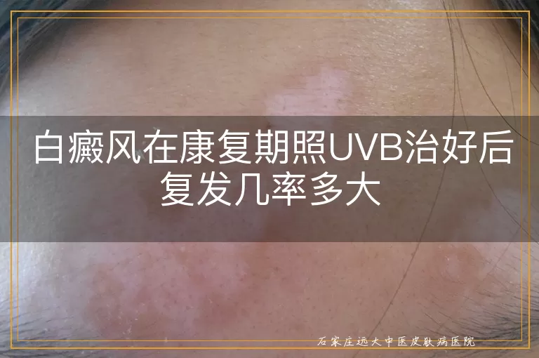 白癜风在康复期照UVB治好后复发几率多大