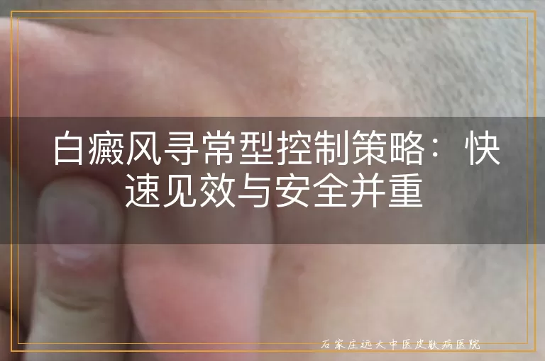 白癜风寻常型控制策略：快速见效与安全并重