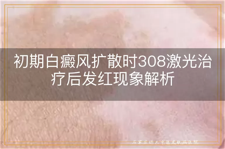 初期白癜风扩散时308激光治疗后发红现象解析