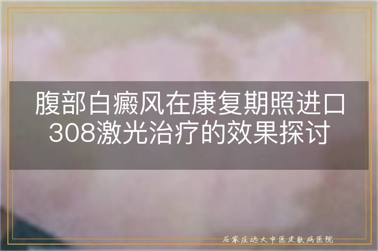腹部白癜风在康复期照进口308激光治疗的效果探讨