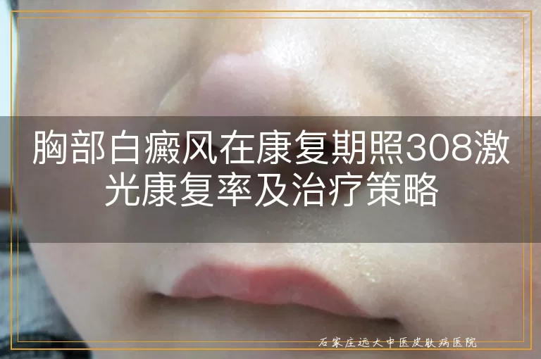胸部白癜风在康复期照308激光康复率及治疗策略