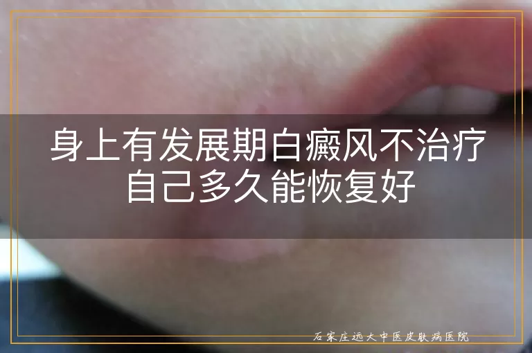 身上有发展期白癜风不治疗自己多久能恢复好