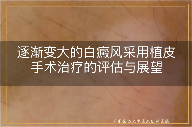 逐渐变大的白癜风采用植皮手术治疗的评估与展望